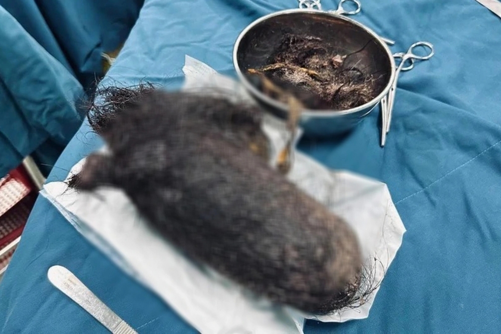 Búi tóc nặng gần 1kg lấy từ dạ dày bé gái 12 tuổi (Ảnh: BVCC)