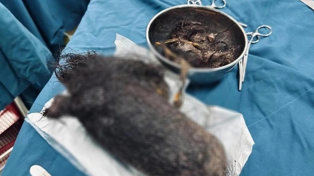 Khối tóc nặng gần 1kg nằm trong dạ dày bé gái