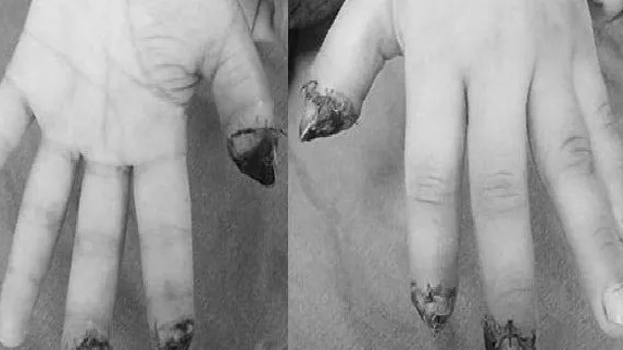 Cháu bé 5 tuổi đứt rời 3 ngón tay trái do máy dập nắp cốc tự động tại nhà