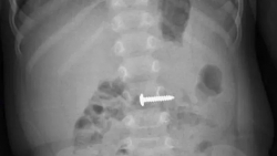 Phẫu thuật thành công cứu cháu bé 34 tháng tuổi nuốt phải đinh vít