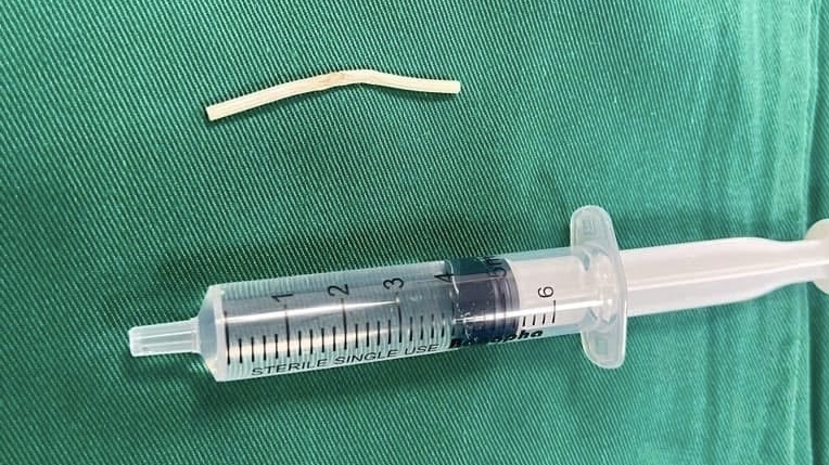 Chuyện hy hữu: Que tránh thai di chuyển vào cơ cánh tay