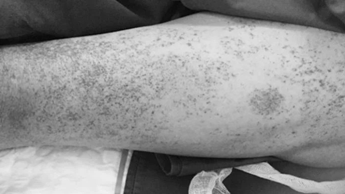 Hà Nội ghi nhận trường hợp mắc liên cầu lợn đầu tiên trong năm nay