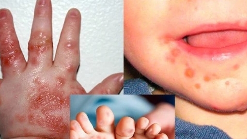 Hà Nội: Số ca mắc tay chân miệng tại có xu hướng gia tăng
