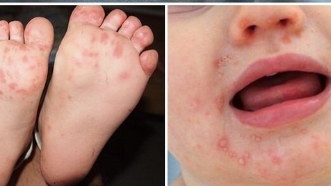 Hà Nội đang cao điểm dịch chân tay miệng