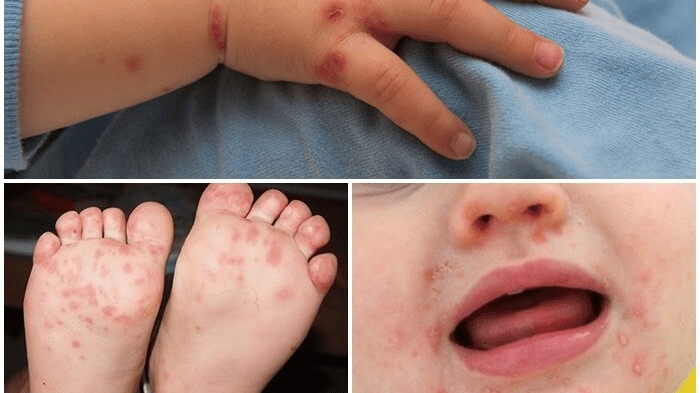 Hà Nội tăng cường phòng, chống bệnh sởi và tay chân miệng