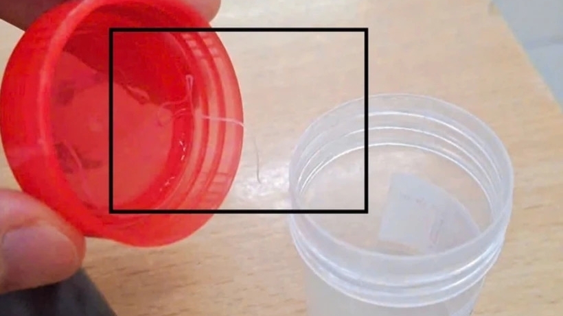 Ký sinh trùng dài gần 10cm trú ẩn trong mắt người