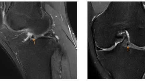 Cảnh giác với triệu chứng đau khớp gối do va chạm