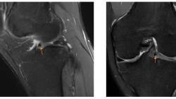 Cảnh giác với triệu chứng đau khớp gối do va chạm