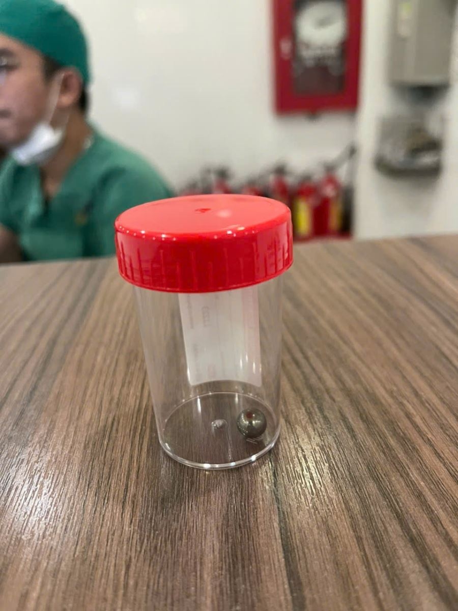 Viên bi sắt từ súng đồ chơi xuyên thủng vùng má trái của bé trai (Ảnh: BVCC)