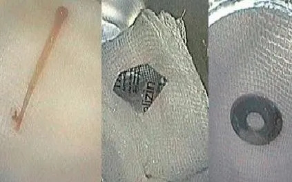 Những dị vật được bác sĩ Bệnh viện Hùng Vương Gia Lai  gắp thành công dị vật đường tiêu hoá