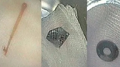 Cấp cứu trường hợp nuốt dị vật đường tiêu hóa