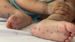 Hà Nội: Ca mắc tay chân miệng tăng mạnh ở nhóm trẻ ≤ 3 tuổi