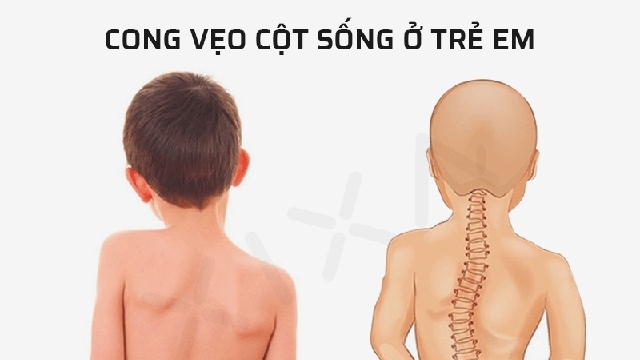 Khám miễn phí bệnh l‎ý gù, vẹo cột sống ở trẻ em