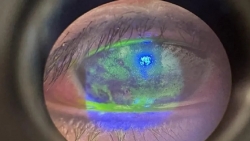 bong giac mac nang do nho nham dau gio vao mat