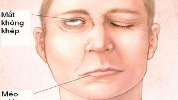 Liệt mặt do thời tiết thay đổi đột ngột