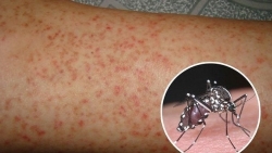 Suýt mất mạng vì sốc sốt xuất huyết Dengue nặng