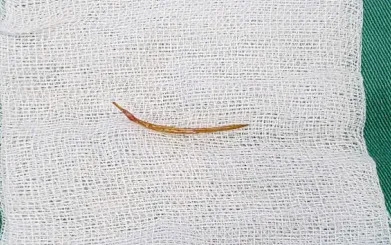 Bác sĩ gắp thành công xương cá ra khỏi đại tràng bệnh nhân L.B.S. (Ảnh: BVCC) Bác sĩ gắp thành công xương cá ra khỏi đại tràng bệnh nhân L.B.S. (Ảnh: BVCC)