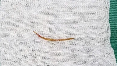 Liên tiếp các ca thủng nội tạng do xương cá