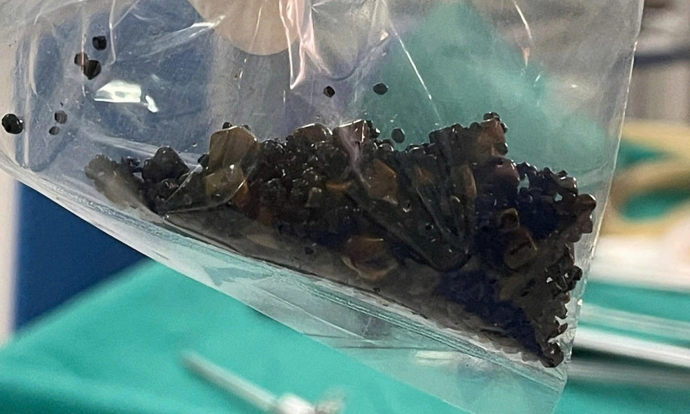 Hàng trăm viên sỏi trong túi mật bệnh nhân được bác sĩ lấy ra ngoài. Ảnh: Bệnh viện cung cấp