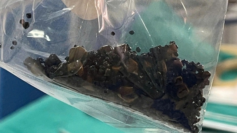 Bệnh nhân có 2 túi mật hai ngăn hiếm gặp, chứa hàng trăm viên sỏi