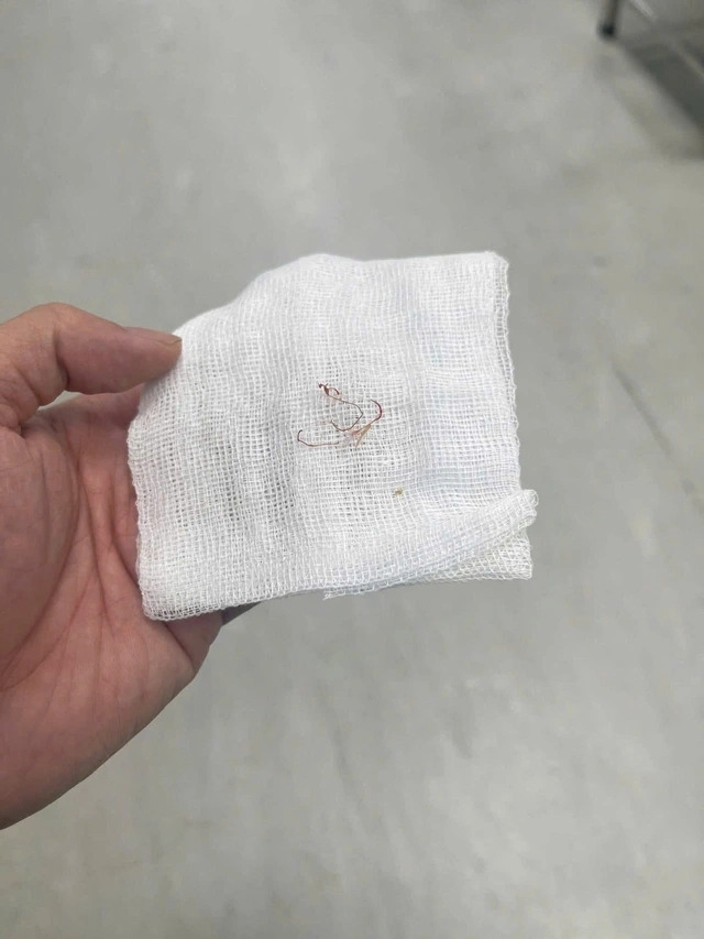 Dị vật là sợi chỉ ở vùng má đã được bác sĩ lấy ra thành công Dị vật là sợi chỉ ở vùng má đã được bác sĩ lấy ra thành công