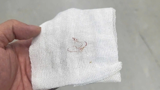 Biến chứng  sau phẫu thuật tạo má lúm đồng tiền tại spa không uy tín