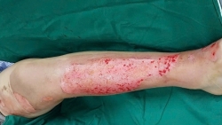 ton thuong nang do tu dap thuoc la chua bong tai nha