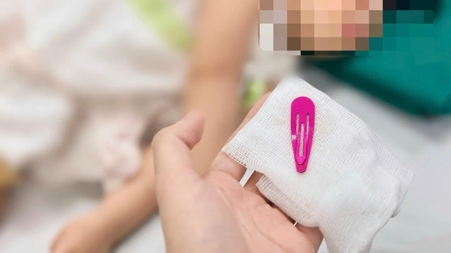 Gắp kẹp tóc sắc nhọn trong dạ dày bé gái