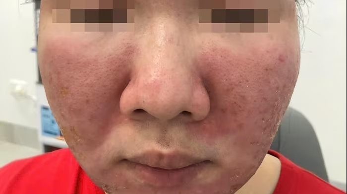 Mặt bỏng rát, thâm sạm sau khi dùng kem chống nắng mua trên mạng