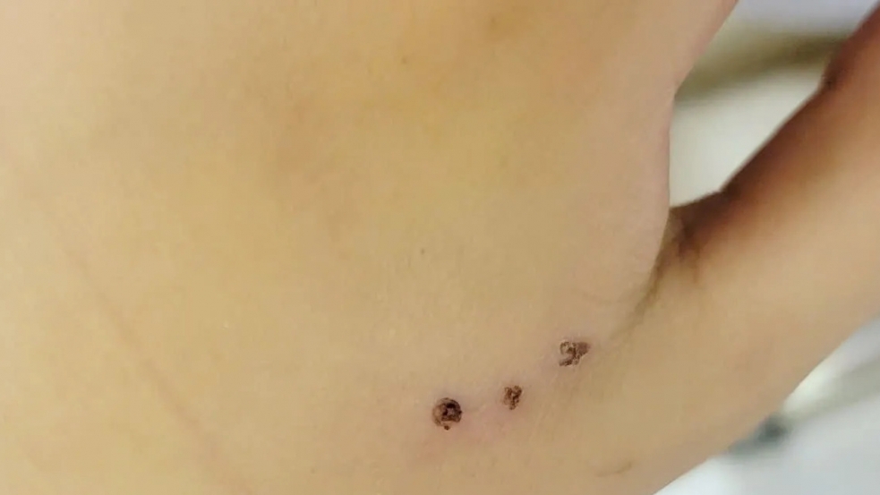 Không chủ quan vết chuột cắn