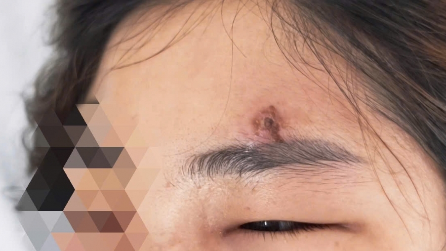 Nặn mụn bằng tay, người phụ nữ phải đi cấp cứu