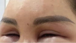 Tiêm meso trẻ hoá, một phụ nữ bị sưng nề toàn bộ khuôn mặt