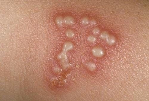  là một loại virus thích da và thần kinh, thường gây ra tình trạng nhiễm trùng tái phát ảnh hưởng đến da, miệng, môi, mắt và bộ phận sinh dục…