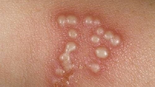 Nhiễm virus Herpes sau khi xăm làm đẹp