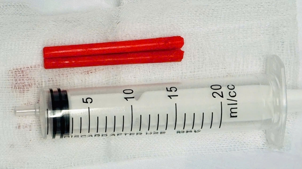 Bệnh nhân bị đôi đũa đâm xuyên mũi hơn một năm mới được phát hiện