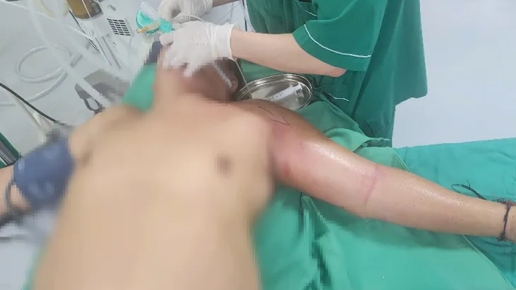 Hoại tử tay vì tự ý tiêm mật gấu chữa bệnh