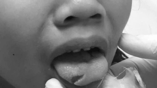 Bé gái 7 tuổi bị kéo cắt vào lưỡi trong lúc chơi đùa