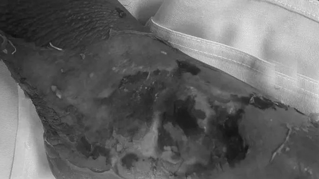 Thêm trường hợp nhiễm trùng nặng vì tự ý đắp thuốc nam