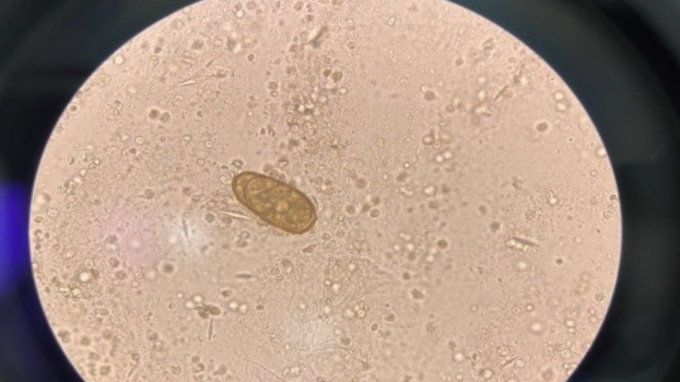 di kham khong phat hien benh hoa ra nhiem san la phoi