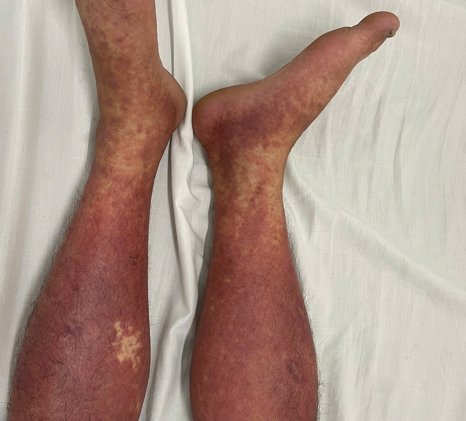 Nhiều trường hợp dị ứng nặng vì tự ý dùng thuốc cấm trị đau khớp