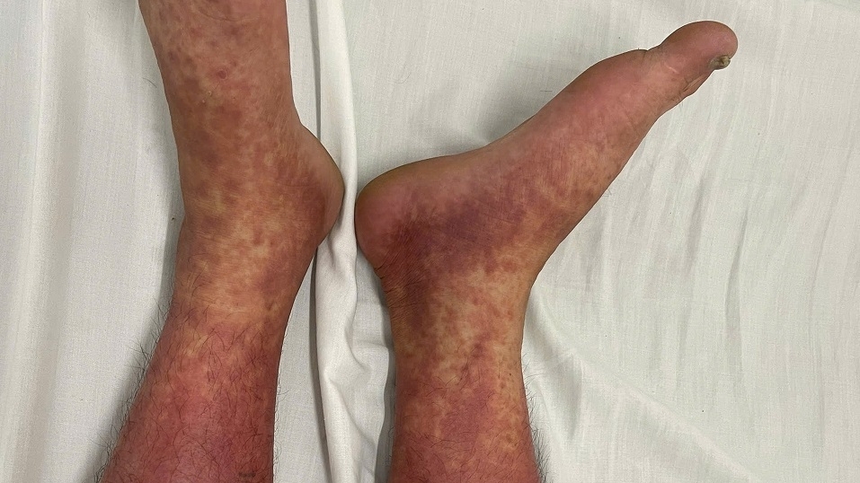 Nhiều trường hợp dị ứng nặng vì tự ý dùng thuốc cấm trị đau khớp