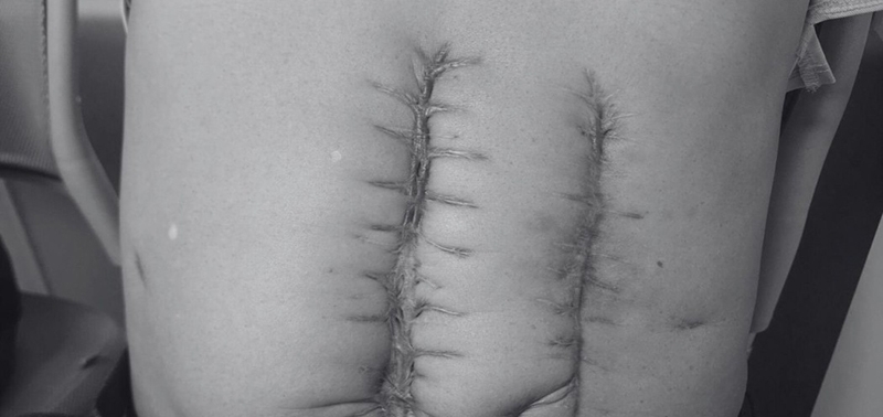 Bệnh nhân đã trải qua 7 lần mổ hoại tử ruột 