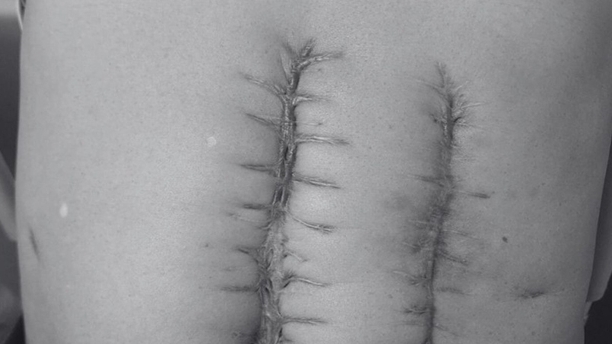 Mổ hoại tử ruột 7 lần mới phát hiện đúng bệnh