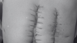 Mổ hoại tử ruột 7 lần mới phát hiện đúng bệnh