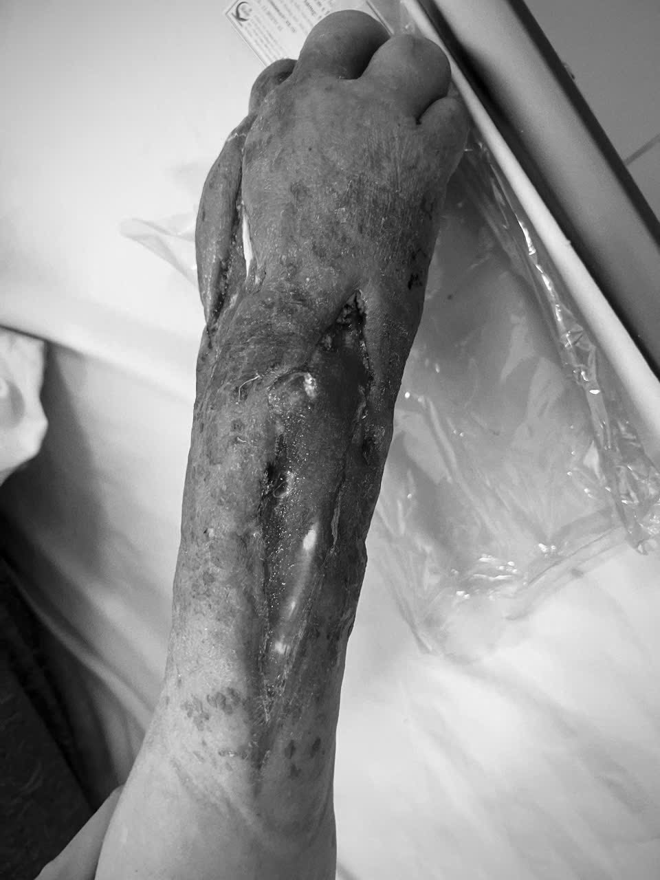 Phần tay của ông P đã bị hoại tử (Ảnh; BVCC)