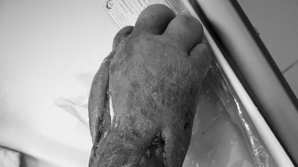 Bệnh nhân người Mông mắc bệnh hiếm gặp