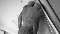 benh nhan nguoi mong mac benh hiem gap