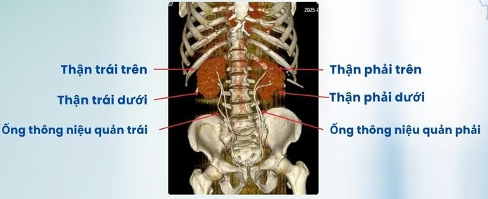 Hình ảnh dựng từ phim chụp CT Scanner 3D cho thấy hệ tiết niệu của người bệnh có dị tật thận đôi hai bên (Ảnh: BVCC)