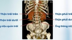 Bệnh nhân bị dị tật thận đôi cực hiếm