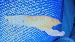 Mảnh xương gà găm trong thực quản cậu bé 8 tuổi